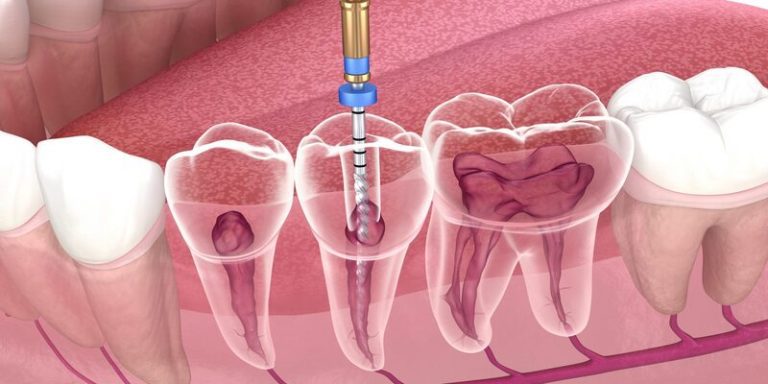 endodoncija